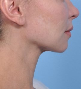 FaceTite - After - Example 2