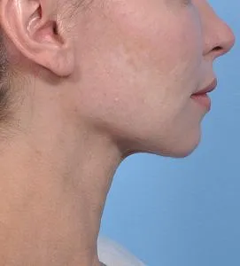 FaceTite - After - Example 2