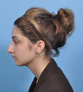 Rhinoplasty - Before - Example 17
