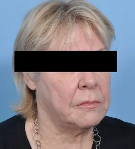 FaceTite - After - Example 5