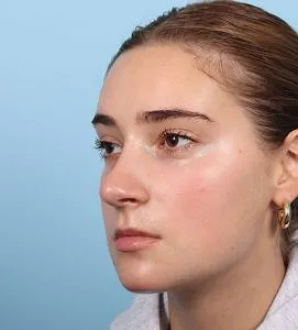 Rhinoplasty - After - Example 5