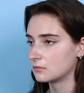 Rhinoplasty - Before - Example 5