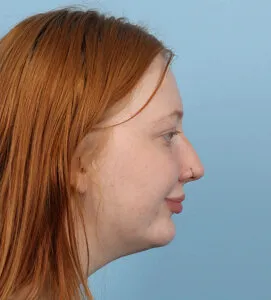 Chin implant After (2)