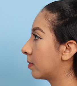 Chin implant After (3)