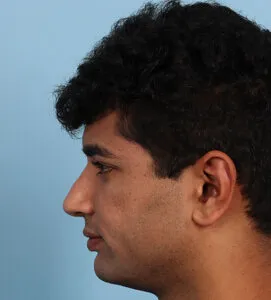 Chin implant After (4)