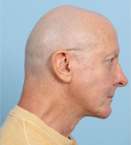 Chin implant After (5)