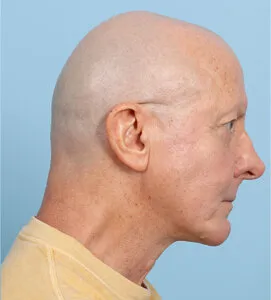 Chin implant After (5)