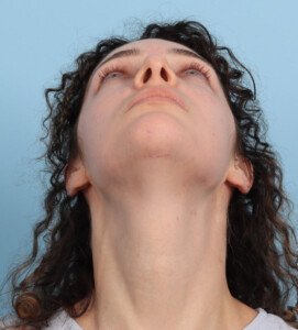 Chin implant After (6)