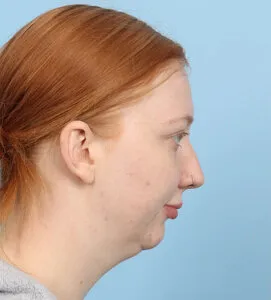 Chin implant Before (2)