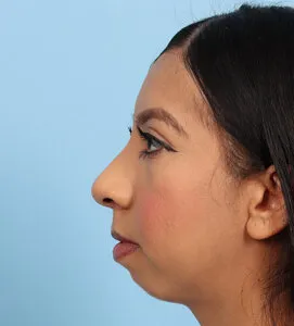 Chin implant Before (3)