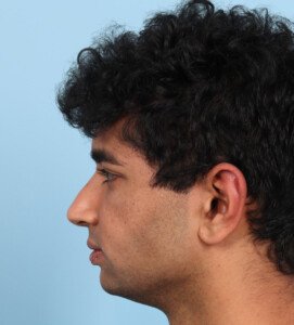 Chin implant Before (4)