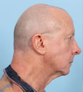 Chin implant Before (5)