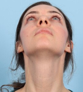Chin implant Before (6)