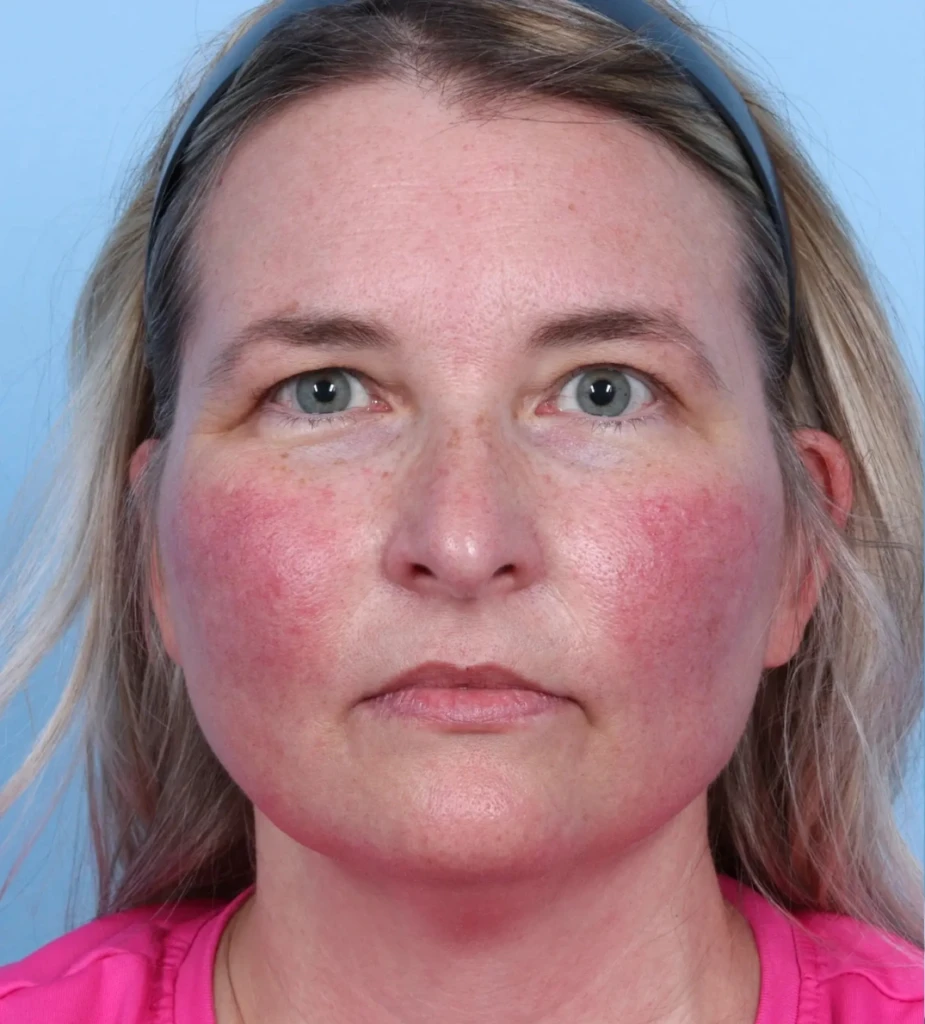 Lasers Before and After Gallery 1