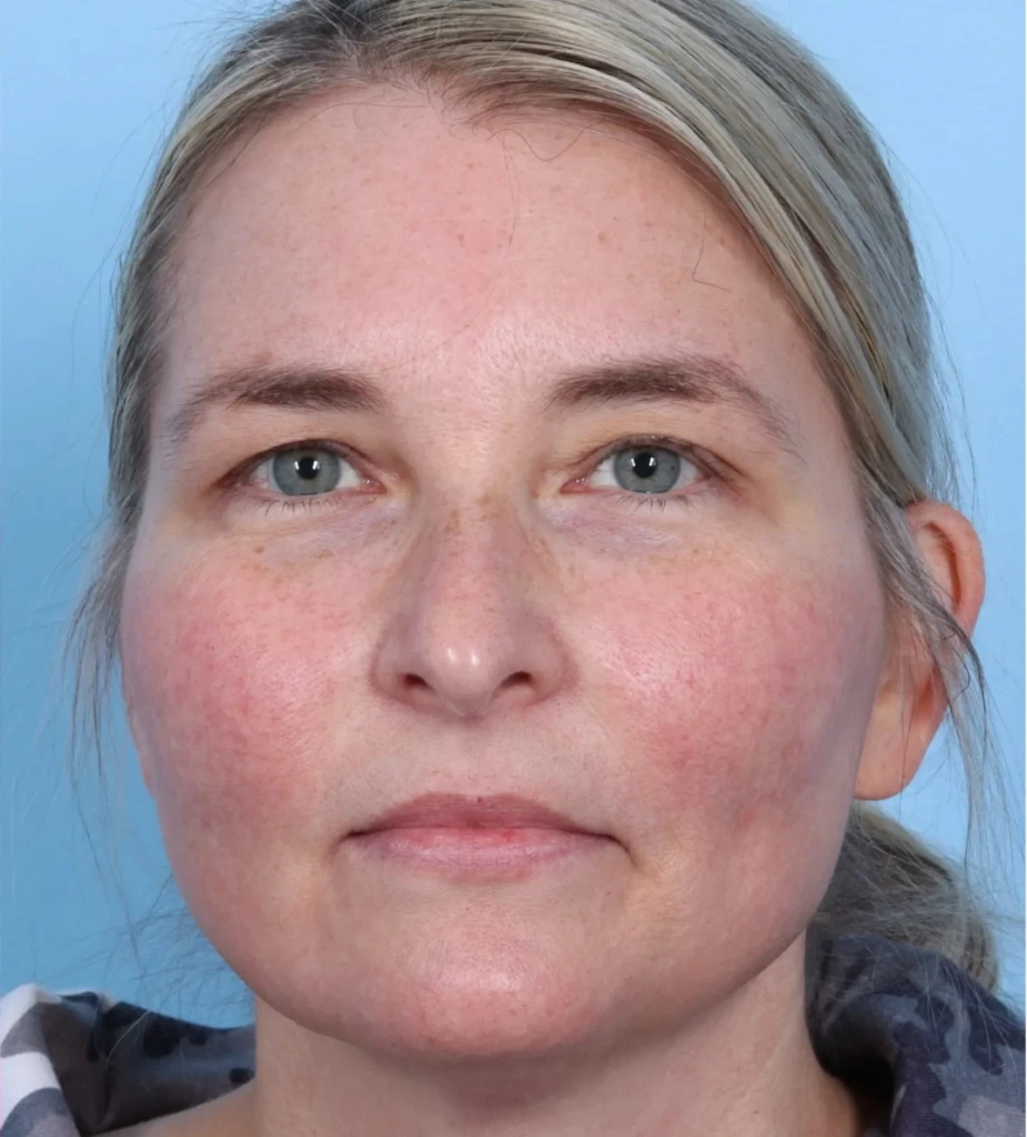 Lasers Before and After Gallery 2