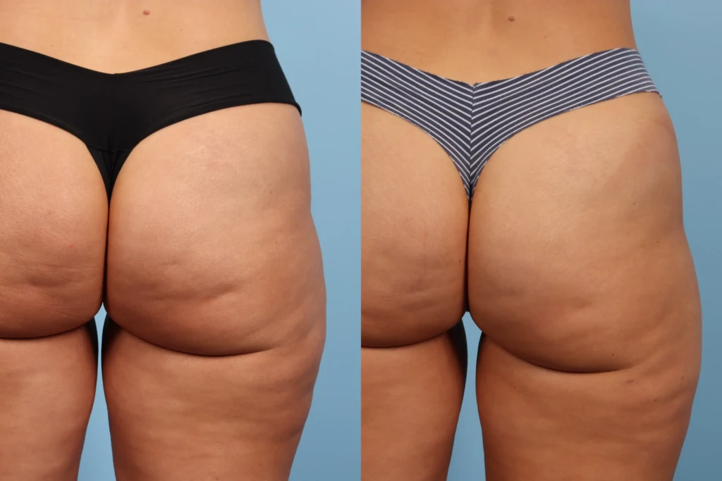 How to reduce cellulite with Avéli™ Cellulite Treatment