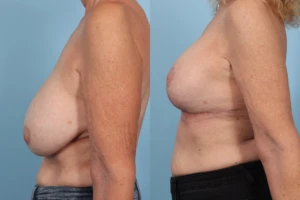 Breast Lift TP3