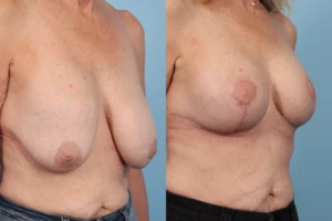 Breast Lift TP4