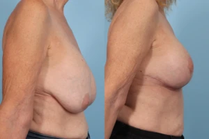 Breast Lift TP5