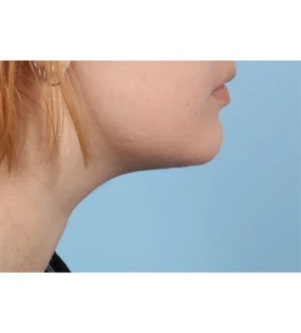 1 MarSmi Neck Contour A 1