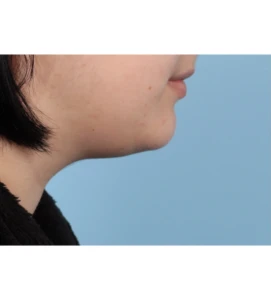 1 MarSmi Neck Contour B 1