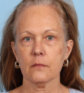 10 RobWhi Frontal b