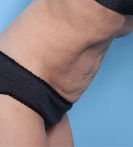 9 GaiMur Emsculpt After