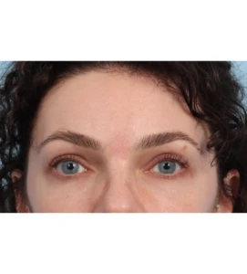 Browlift 1 A