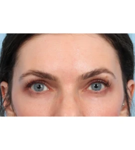 Browlift 1 B
