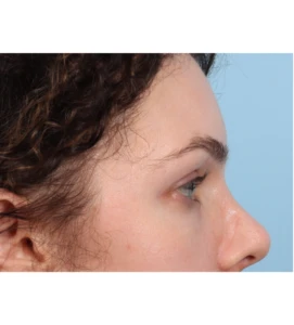 Browlift 2 A