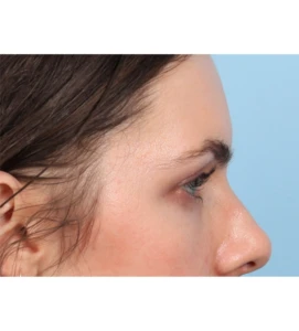 Browlift 2 B