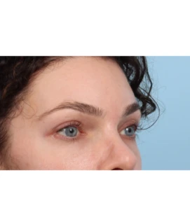 Browlift 3 A