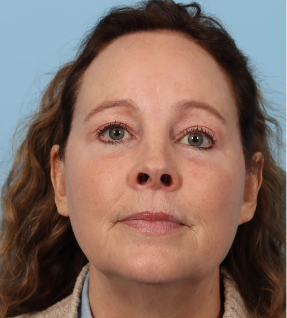Browlift 4 A