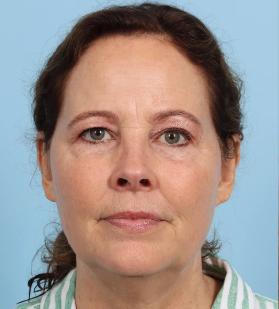 Browlift 4 B