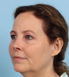 Browlift 5 B