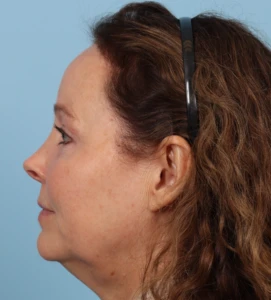 Browlift 6 A