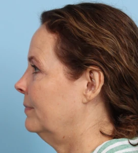 Browlift 6 B