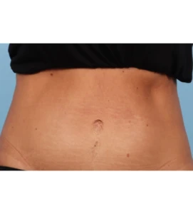 Emsculpt Aub A 1