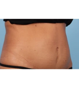 Emsculpt Aub A 2