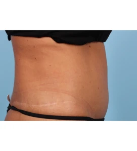 Emsculpt Aub A 3