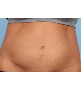 Emsculpt Aub B 1