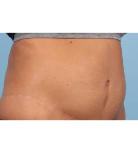 Emsculpt Aub B 2