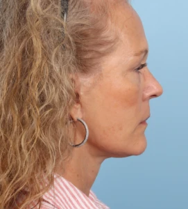 Facelift RobWhi A 1