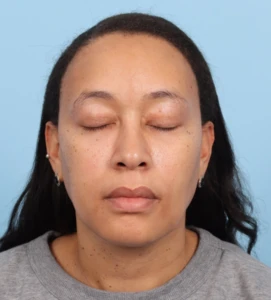 Lower Blepharoplasty 1 A