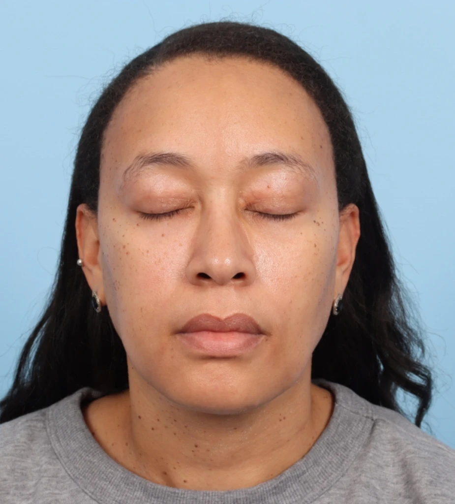 Lower Blepharoplasty 1 A