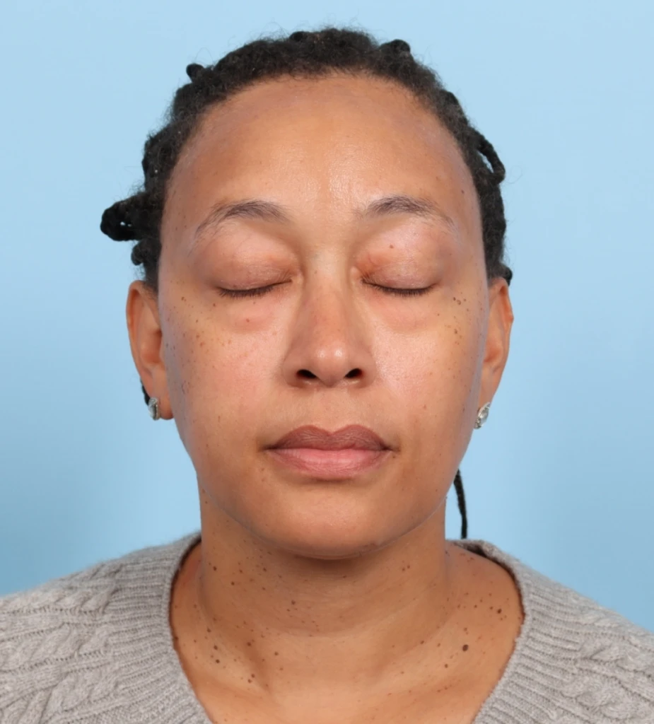 Lower Blepharoplasty 1 B