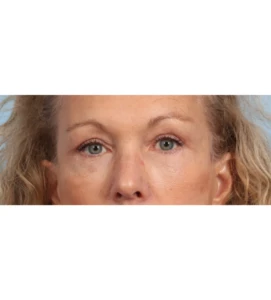 Lower Blepharoplasty 10 A