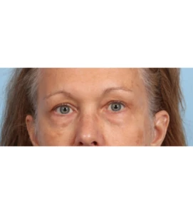 Lower Blepharoplasty 10 B