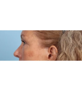 Lower Blepharoplasty 11 A