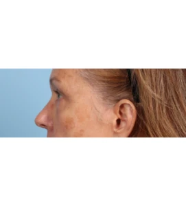 Lower Blepharoplasty 11 B